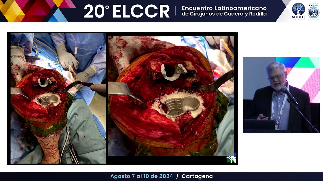Complicaciones intraoperatorias en artroplastia de revisión.