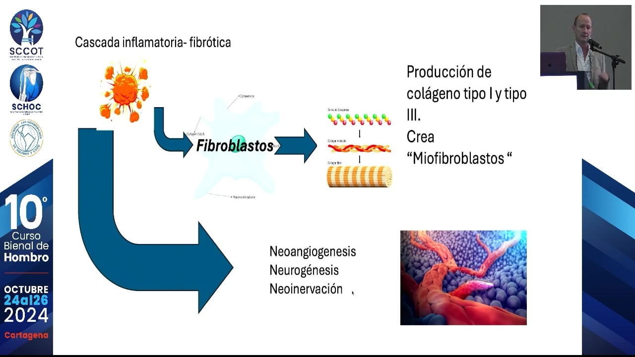 Novedades en manejo y comprensión de la capsulitis adhes