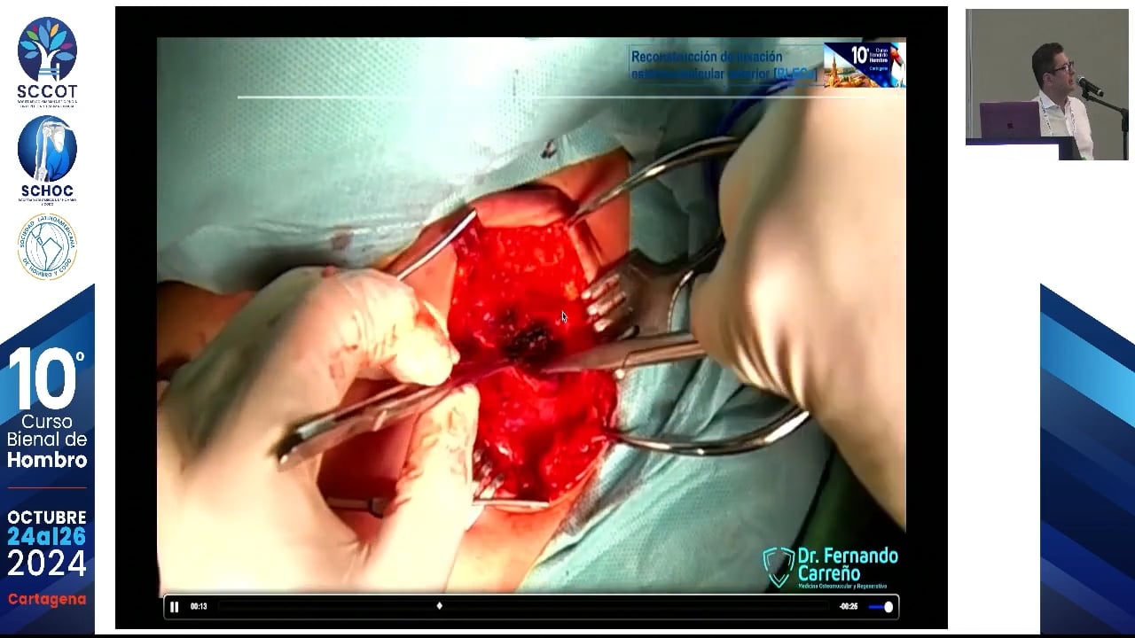 Reconstrucción de luxación externoclavicular Anterior
