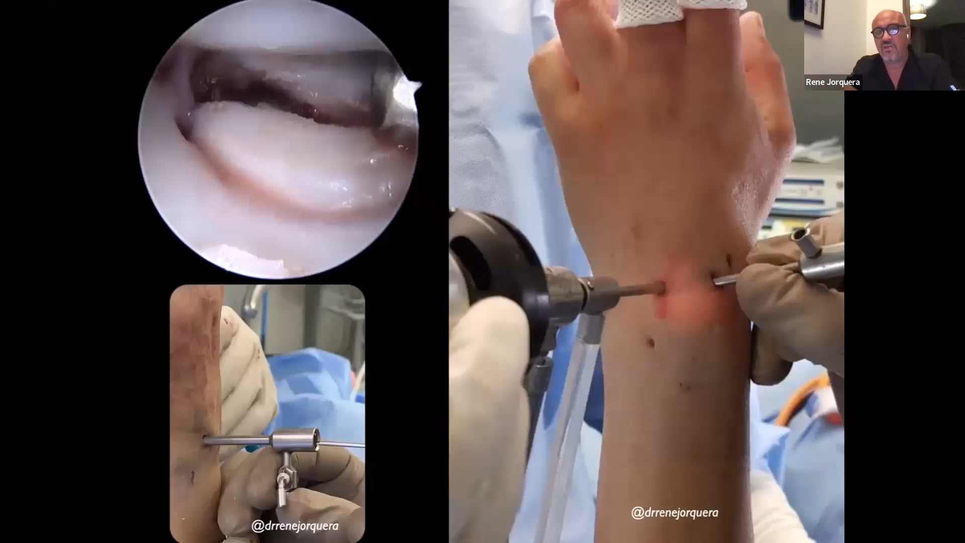 WEBINAR la importancia de la Artroscopia de muñeca en fracturas de escafoides
