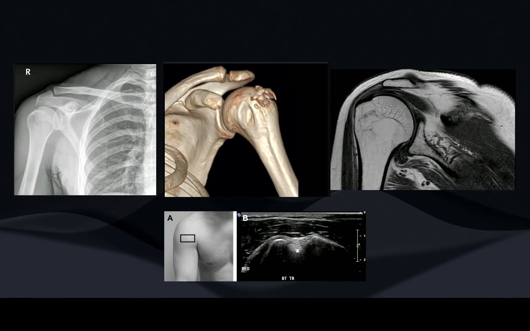 Estudios imagenológicos para una evaluación completa del trauma de hombro