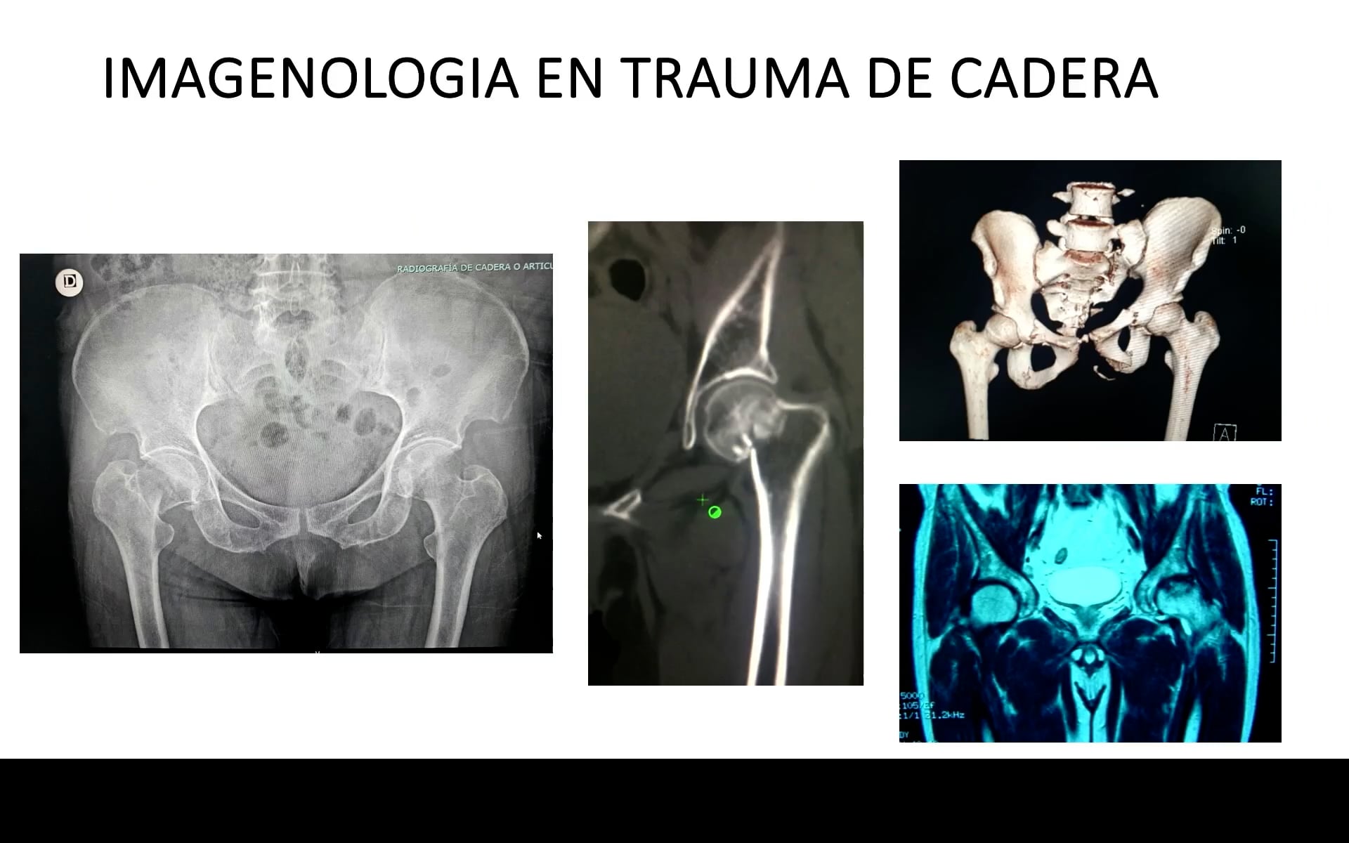 Estudios imagenológicos para una evaluación completa del trauma de cadera