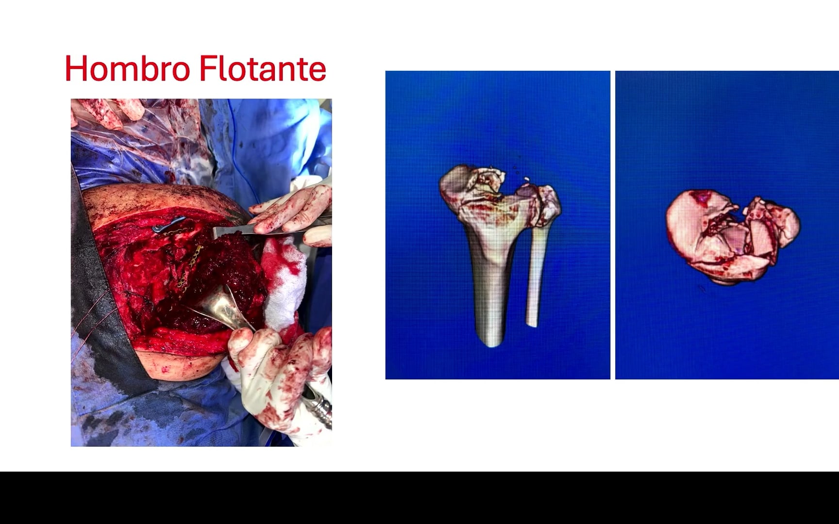 Tratamiento de las lesiones traumáticas de la articulación del hombro