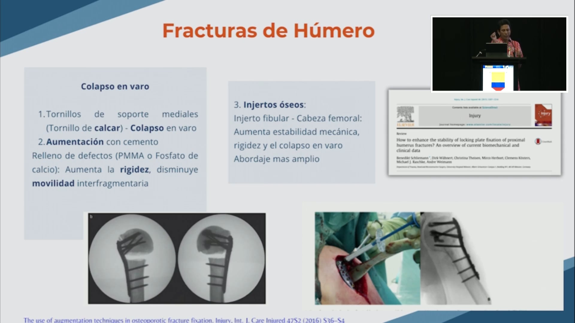 Aumentación en fracturas - Cuándo, cómo y dónde