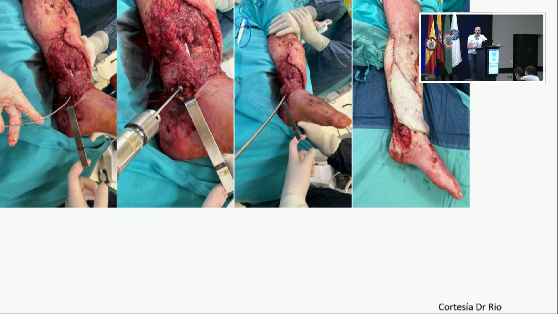 Clavos retrógrados para fracturas de tibia