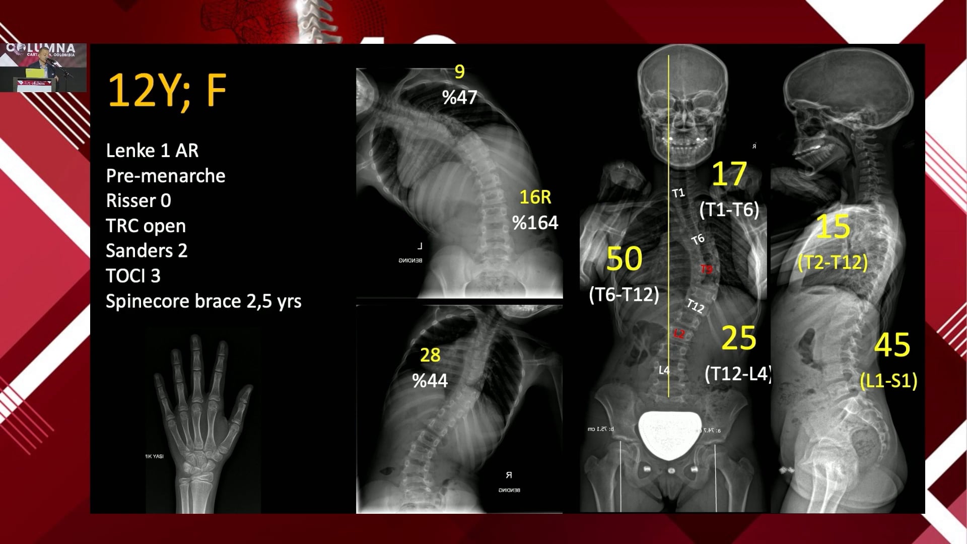Anclaje del cuerpo vertebral