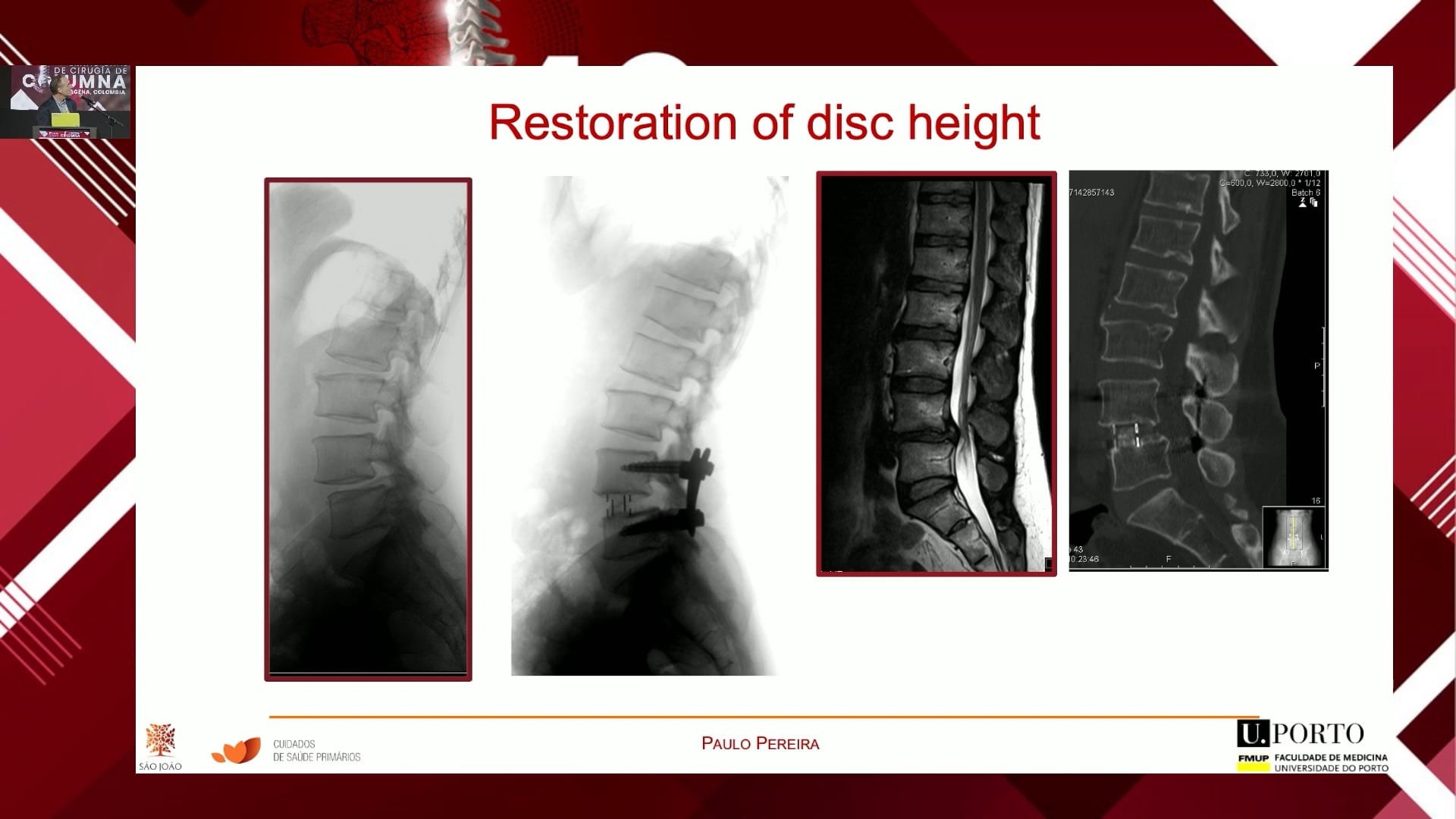 ¿Pueden los abordajes laterales evitar las osteotomías en la deformidad lumbar