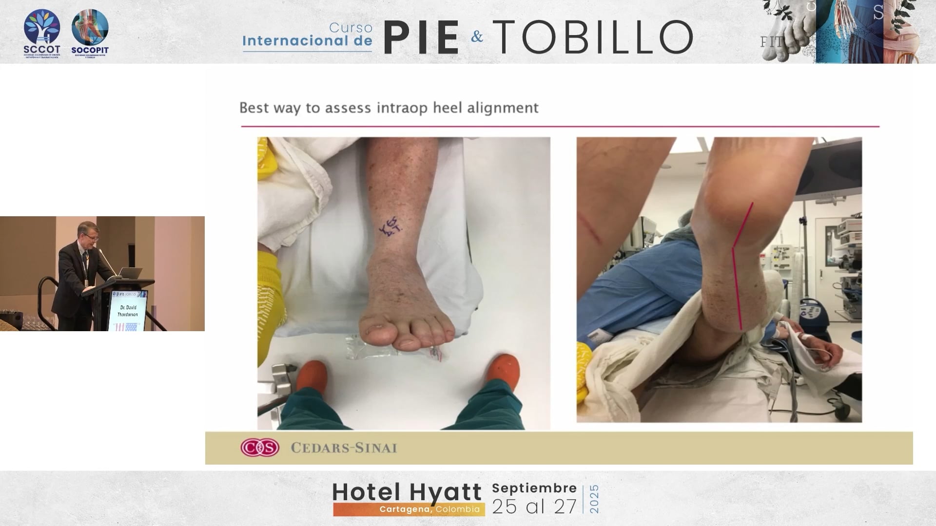 Ostetomia para malalineamiento en RTT