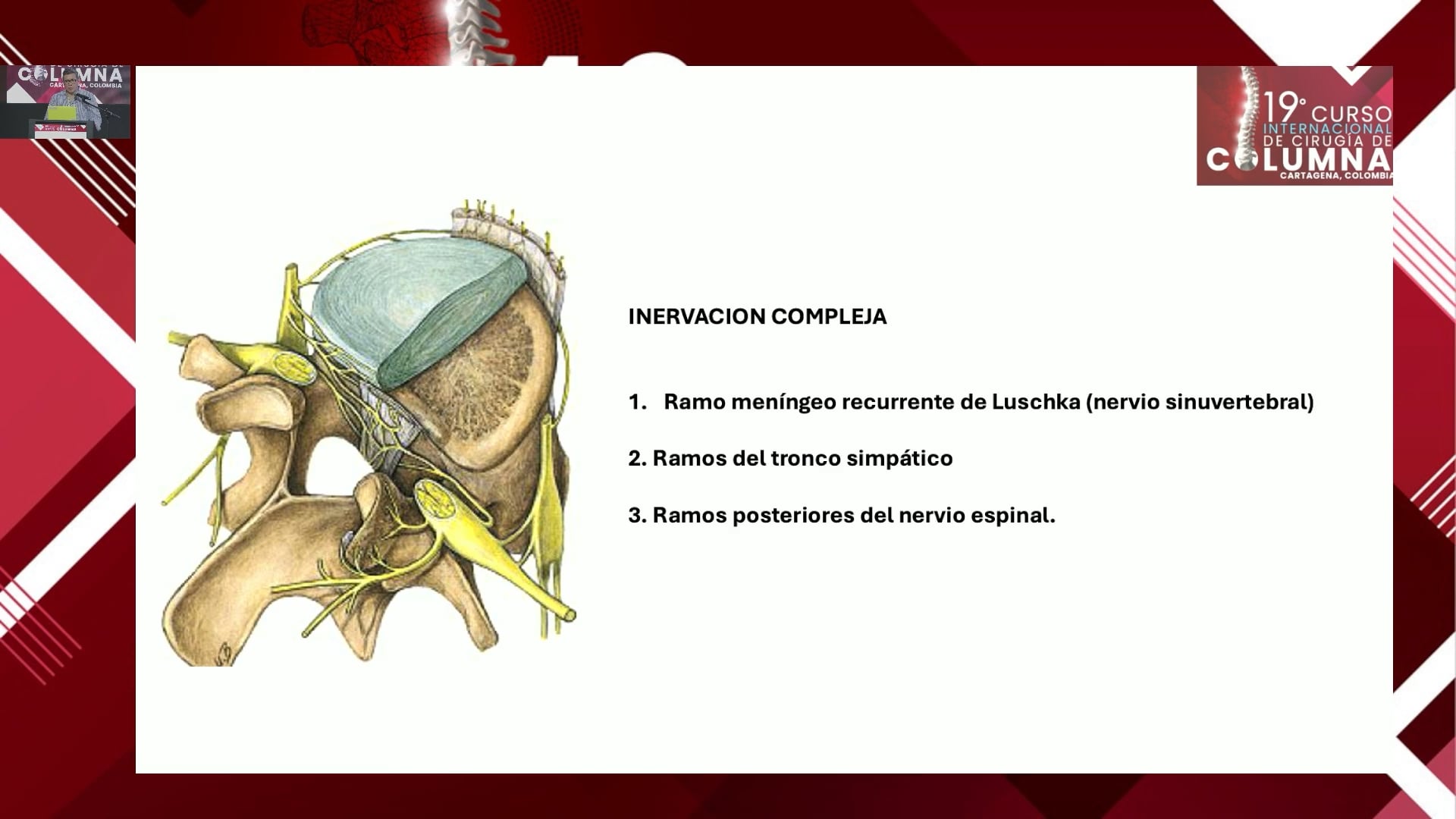 Radiofrecuencia intradiscal para dolor discogénico. Flextrode