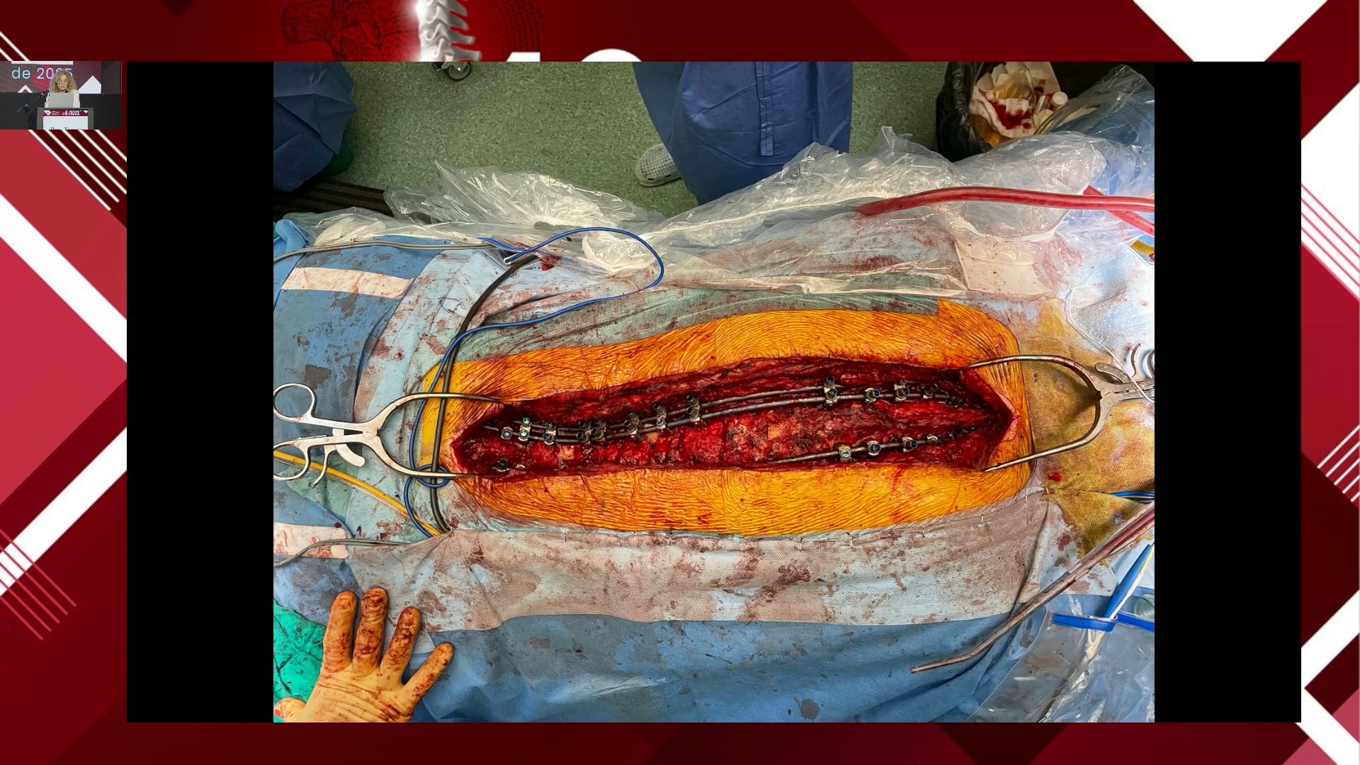 Cirugía de reconstrucción en las deformidades vertebrales Es necesario hacer Osteotomias