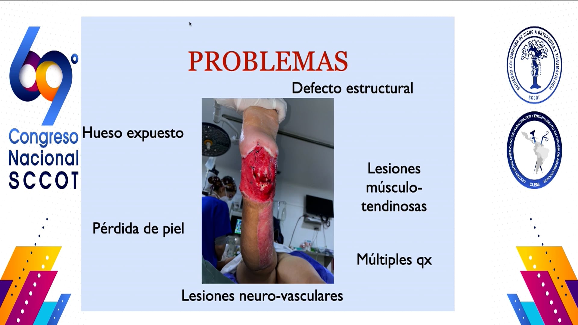 Reconstrucción microquirúrgica de miembro inferior