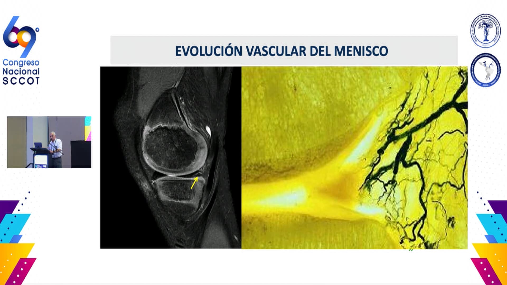 Lesiones meniscales